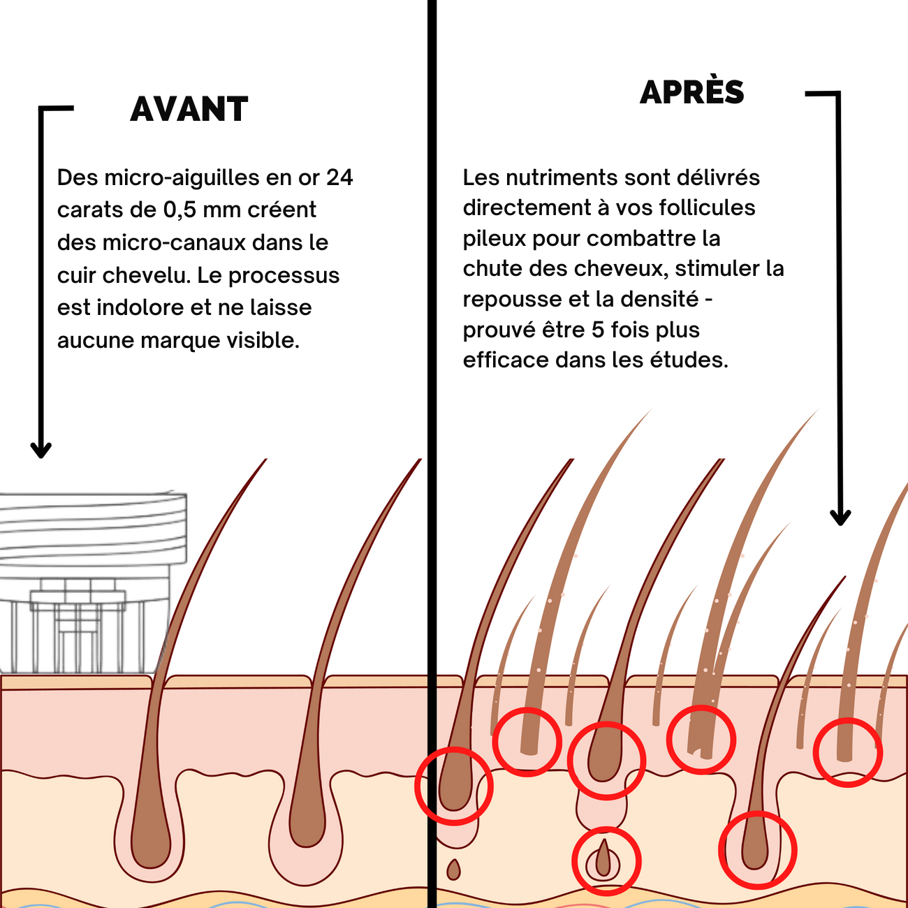 Hairgen Matrix™ Système de Repousse Capillaire