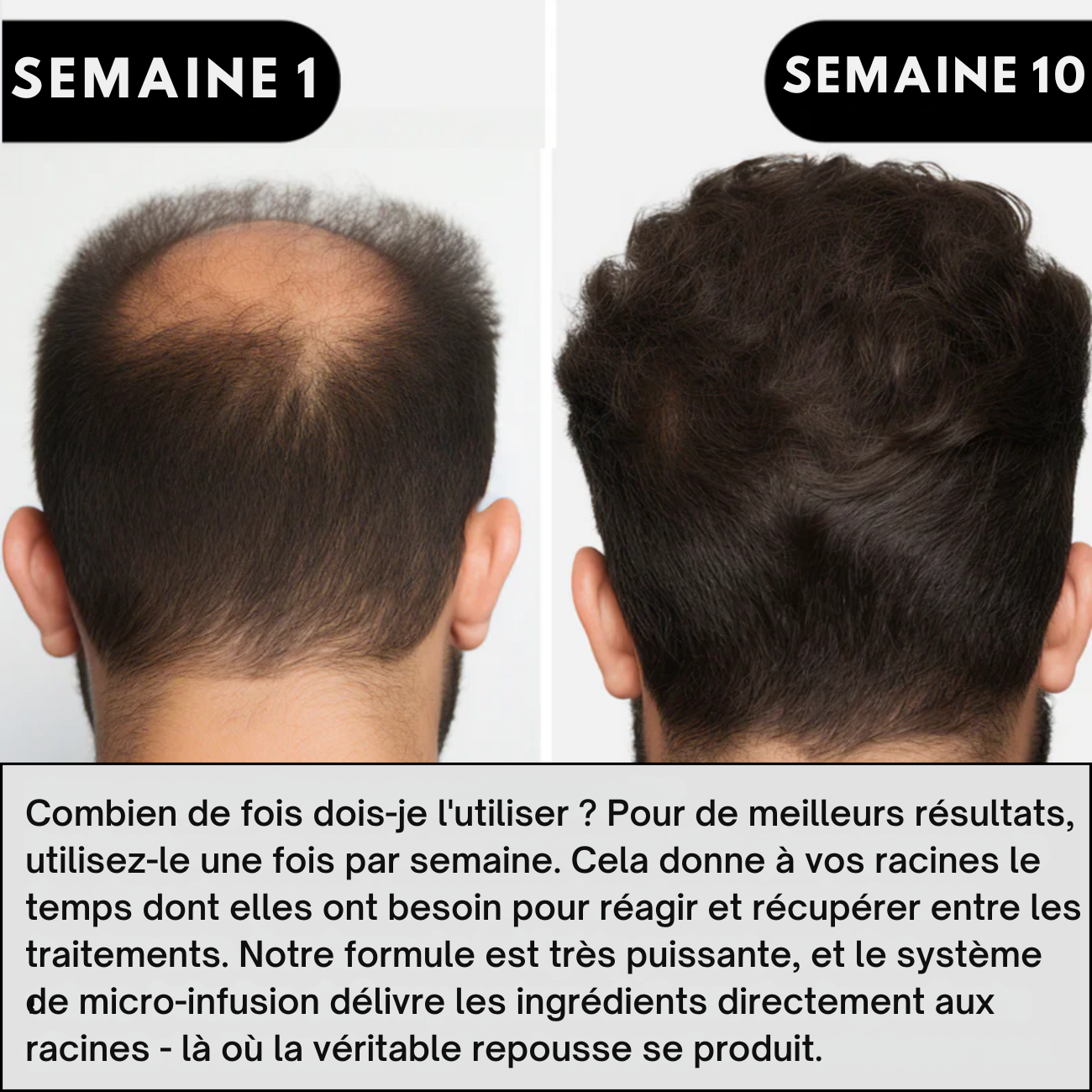 Hairgen Matrix™ Système de Repousse Capillaire