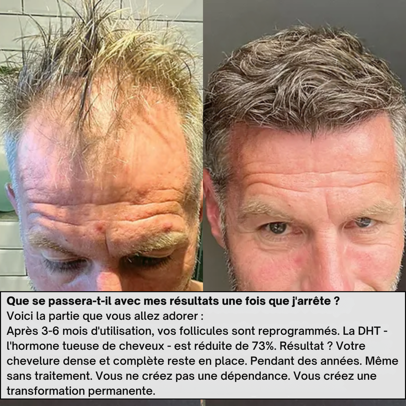 Hairgen Matrix™ Système de Repousse Capillaire