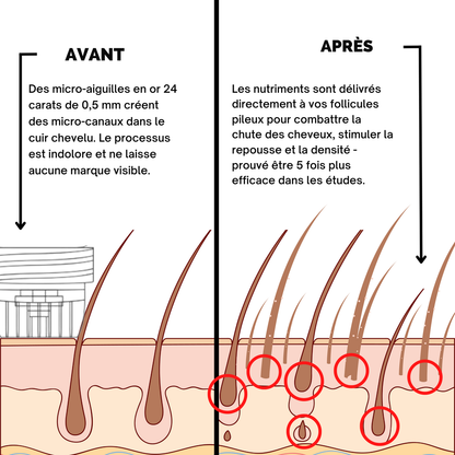 Hairgen Matrix™ Système de Repousse Capillaire