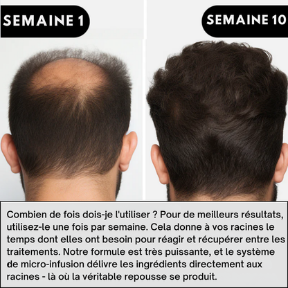 Hairgen Matrix™ Système de Repousse Capillaire